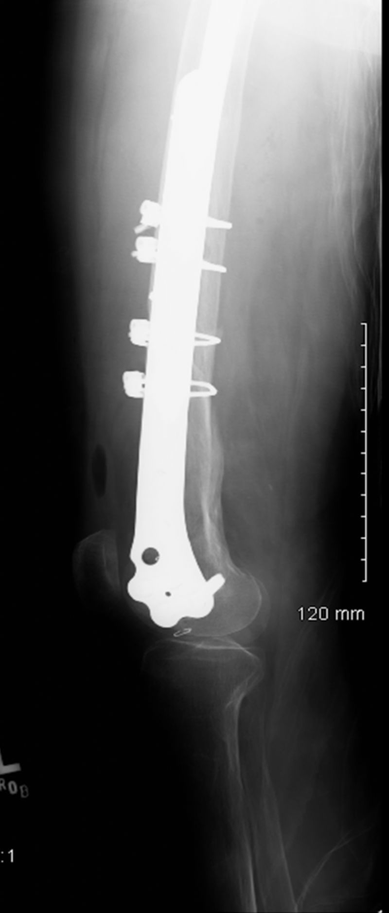 ACCORD Cerclage Cables plus Distal Femur Plate (Implant 4205)